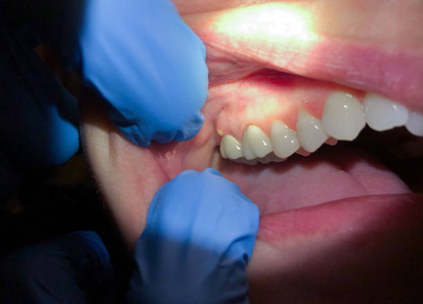 Best Emergency Treatment for Dental Infections or Abscesses in Tuba City, AZ